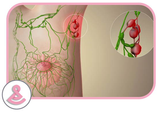 استیجینگ غدد لنفاوی