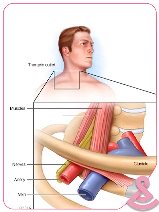 Thoracic Outlet Syndrome