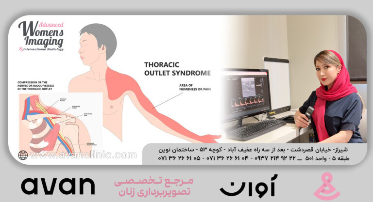 سندروم خروجی قفسه سینه